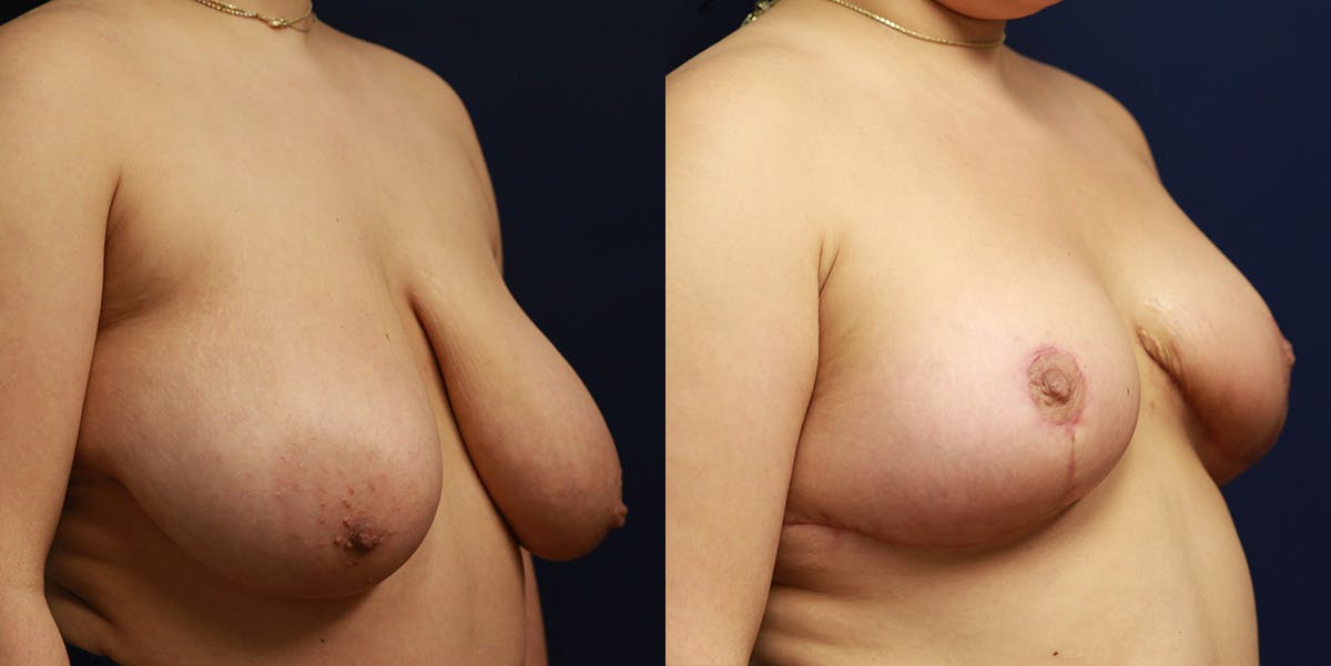 Breast Reduction Before & After Gallery - Patient 223641 - Image 2