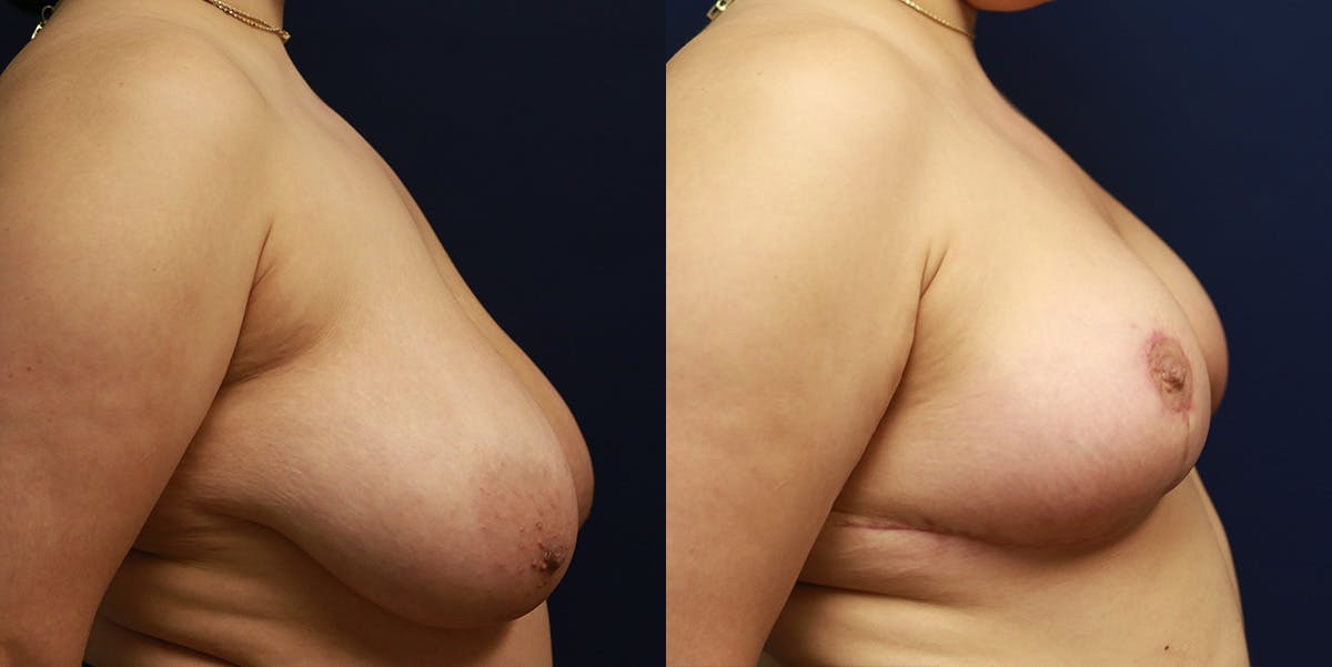 Breast Reduction Before & After Gallery - Patient 223641 - Image 3