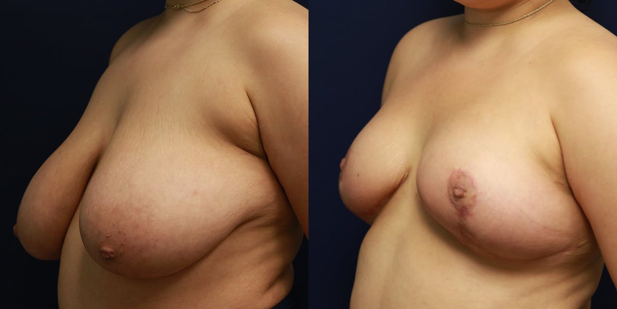Breast Reduction Before & After Gallery - Patient 223641 - Image 4