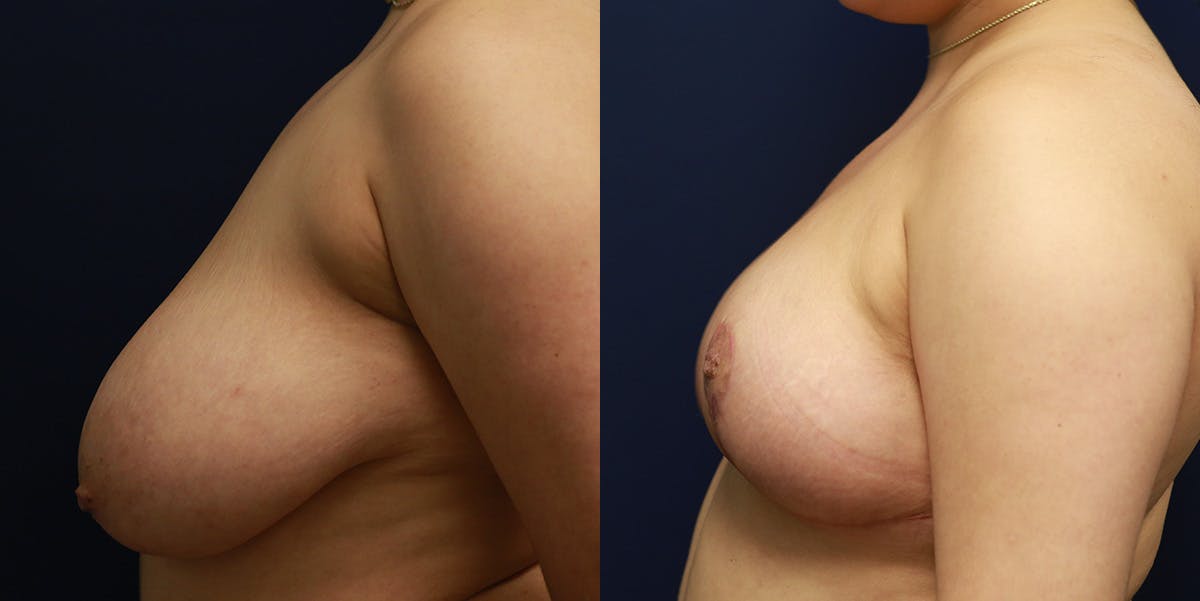 Breast Reduction Before & After Gallery - Patient 223641 - Image 5