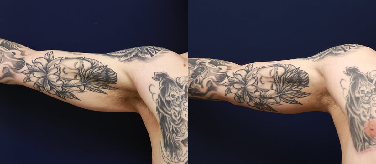 Brachioplasty Before & After Gallery - Patient 640082 - Image 1
