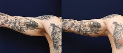 Brachioplasty Before & After Gallery - Patient 640082 - Image 1