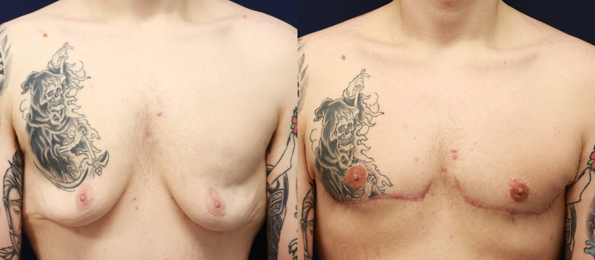 Gynecomastia Before & After Gallery - Patient 311156 - Image 1
