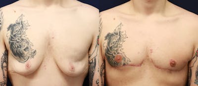 Gynecomastia Before & After Gallery - Patient 311156 - Image 1