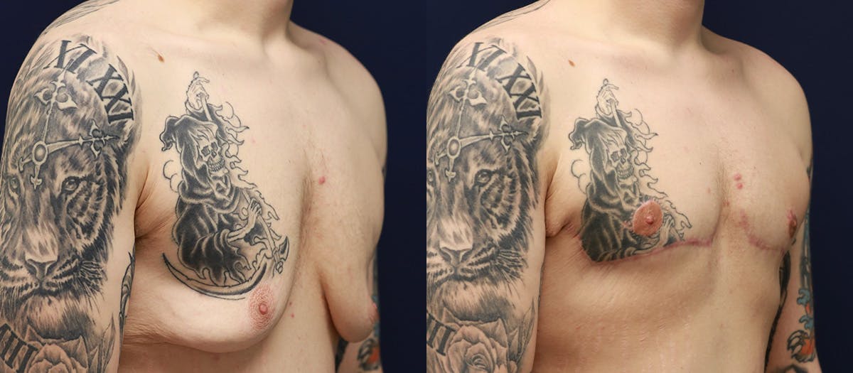 Gynecomastia Before & After Gallery - Patient 311156 - Image 2
