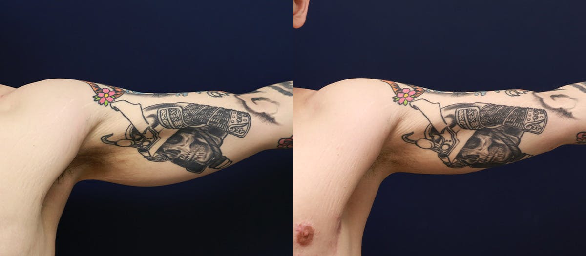 Brachioplasty Before & After Gallery - Patient 640082 - Image 2