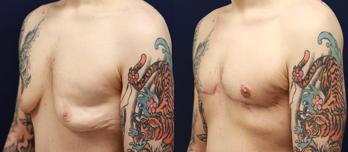 Gynecomastia Before & After Gallery - Patient 311156 - Image 3