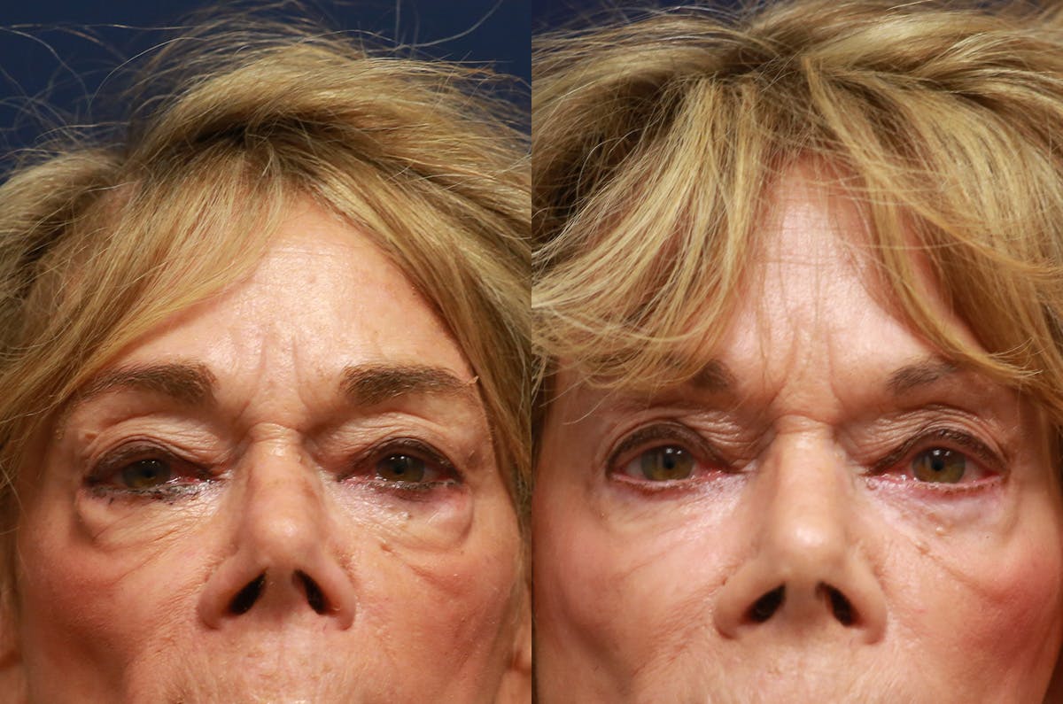 Upper Blepharoplasty Before & After Gallery - Patient 725961 - Image 1