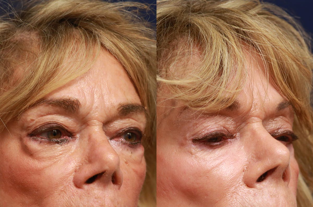 Upper Blepharoplasty Before & After Gallery - Patient 725961 - Image 2