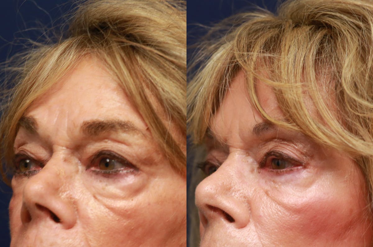 Upper Blepharoplasty Before & After Gallery - Patient 725961 - Image 3