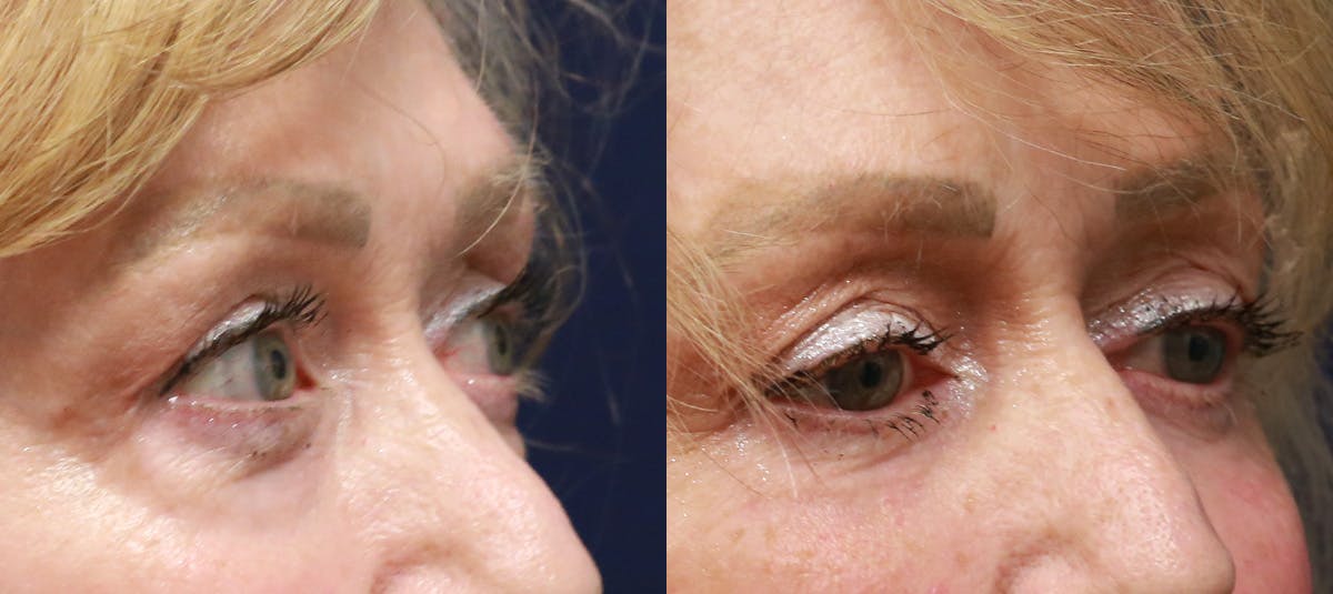 Lower Blepharoplasty Before & After Gallery - Patient 338114 - Image 1