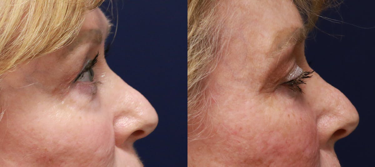Lower Blepharoplasty Before & After Gallery - Patient 338114 - Image 2