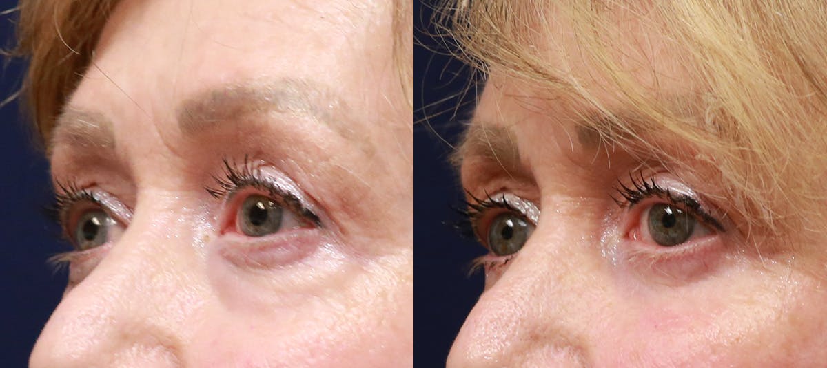 Lower Blepharoplasty Before & After Gallery - Patient 338114 - Image 3