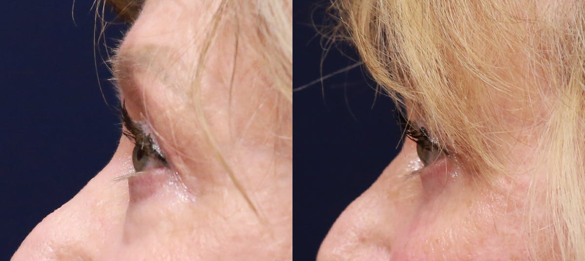 Lower Blepharoplasty Before & After Gallery - Patient 338114 - Image 4
