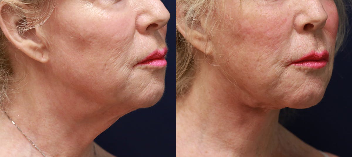 Short Scar Neck Lift Before & After Gallery - Patient 418342 - Image 1