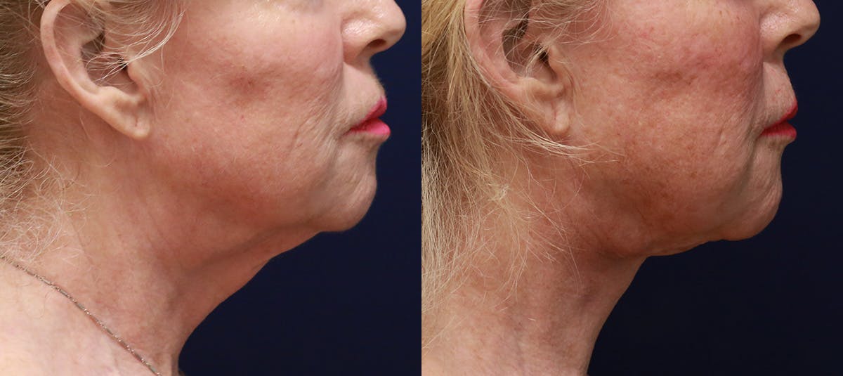 Short Scar Neck Lift Before & After Gallery - Patient 418342 - Image 2