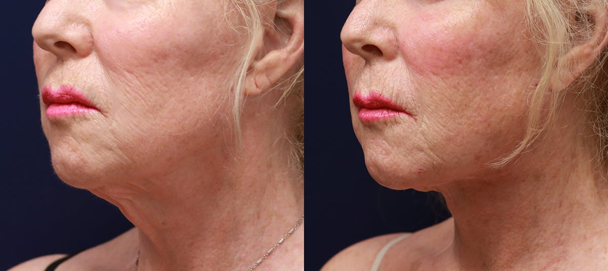 Short Scar Neck Lift Before & After Gallery - Patient 418342 - Image 3