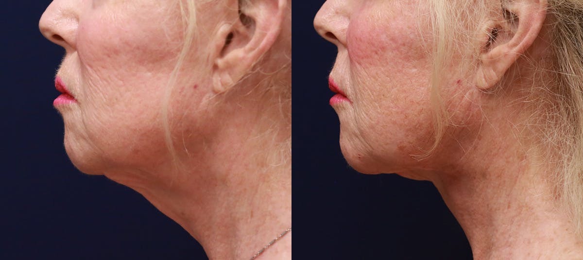 Short Scar Neck Lift Before & After Gallery - Patient 418342 - Image 4