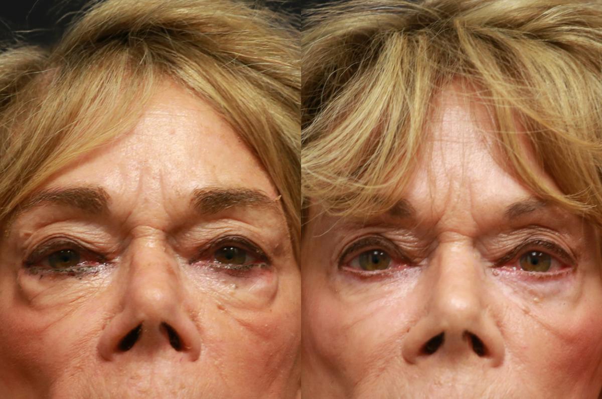 Dr David Parizh Upper Blepharoplasty results