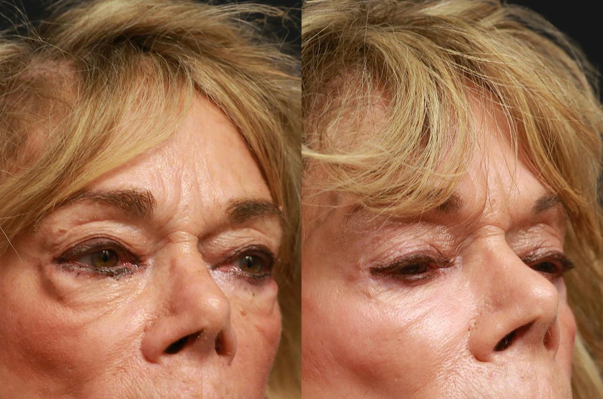 Dr David Parizh Blepharoplasty results