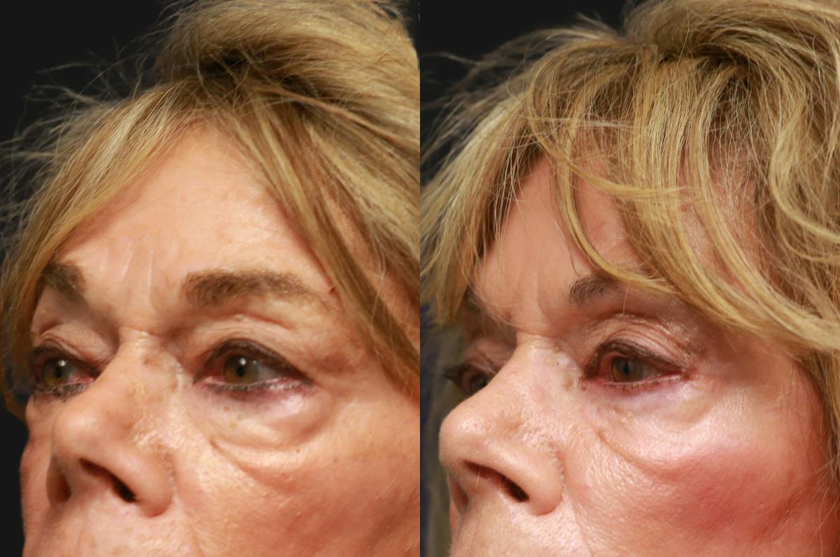 Dr Parizh Upper Eyelid Surgery