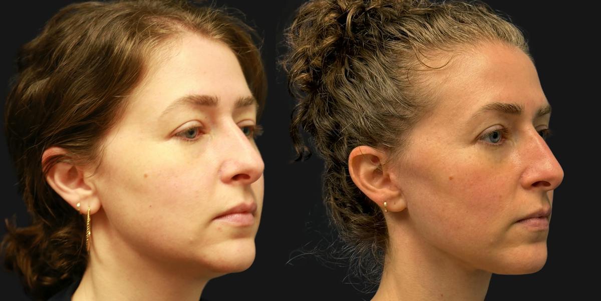 Deep Plane Facelift Before & After Gallery - Patient 402958 - Image 1