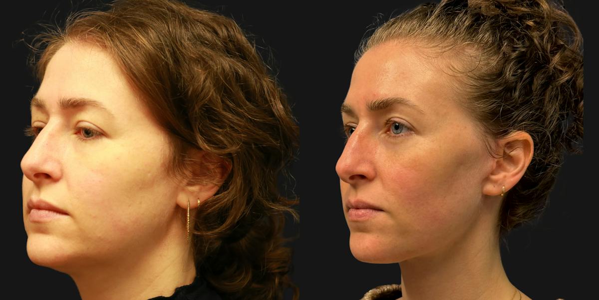 Deep Plane Facelift Before & After Gallery - Patient 402958 - Image 3
