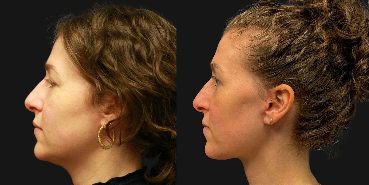 Deep Plane Facelift Before & After Gallery - Patient 402958 - Image 4