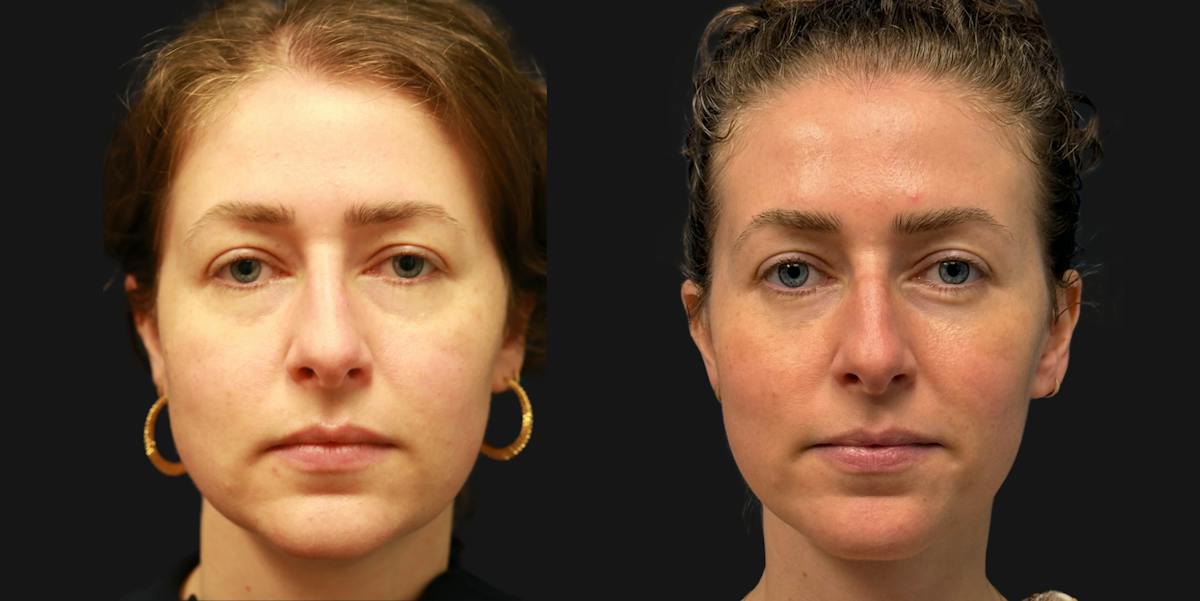 Deep Plane Facelift Before & After Gallery - Patient 402958 - Image 5