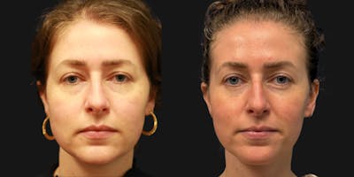 Facial Fat Transfer Before & After Gallery - Patient 200206 - Image 1