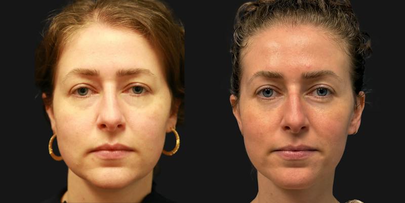 Facial Fat Transfer Before & After Gallery - Patient 200206 - Image 1