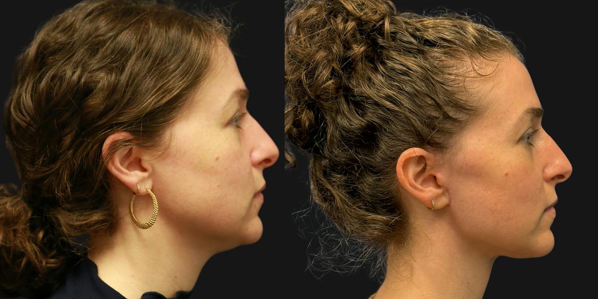 Deep Plane Facelift Before & After Gallery - Patient 402958 - Image 2