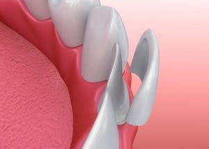 Blog article about whether porcelain veneers are the right option