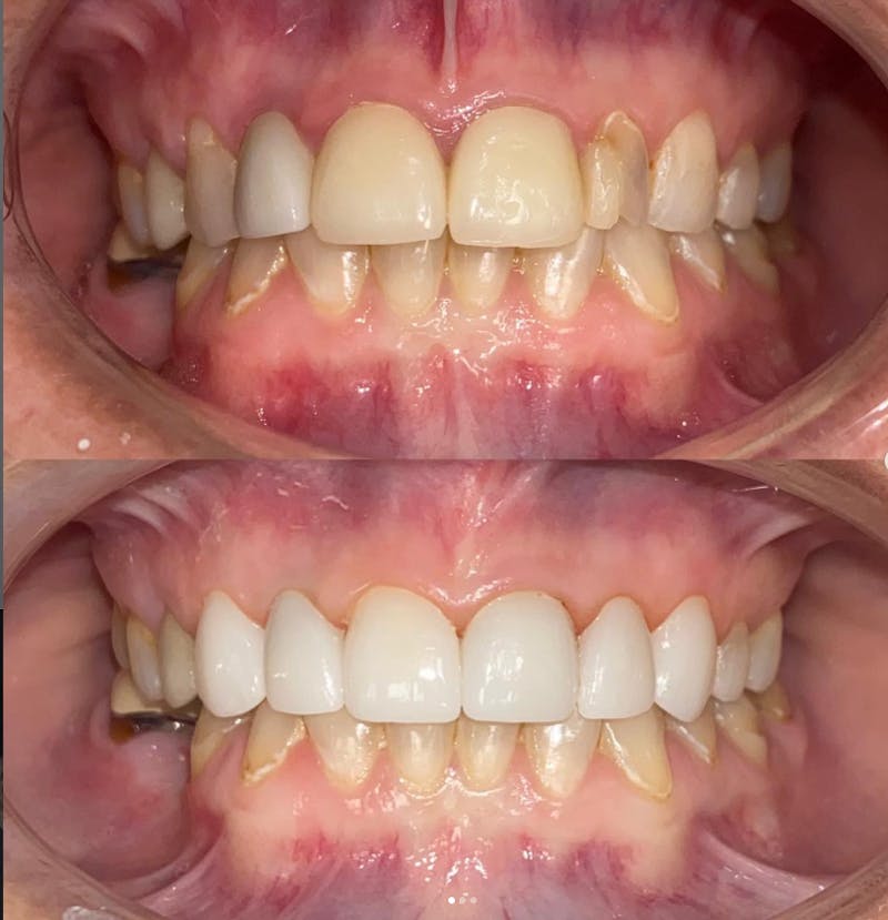 Smile Transformations Before & After Gallery - Patient 102184 - Image 1