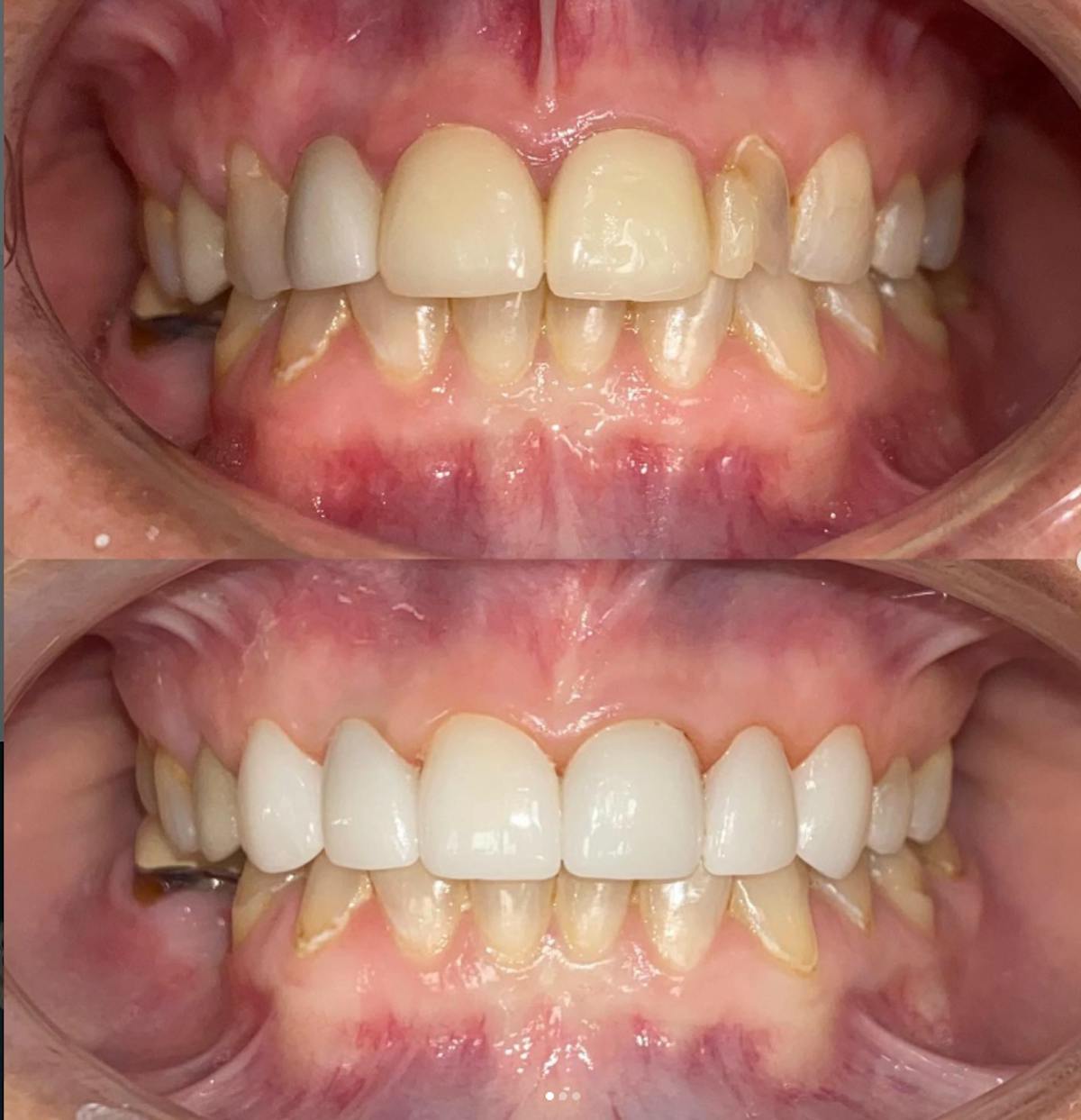 Smile Transformations Before & After Gallery - Patient 102184 - Image 1