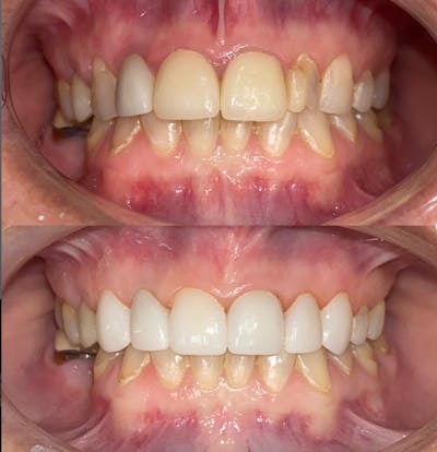 Smile Transformations Before & After Gallery - Patient 102184 - Image 1
