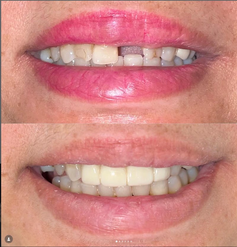 Smile Transformations Before & After Gallery - Patient 234375 - Image 1
