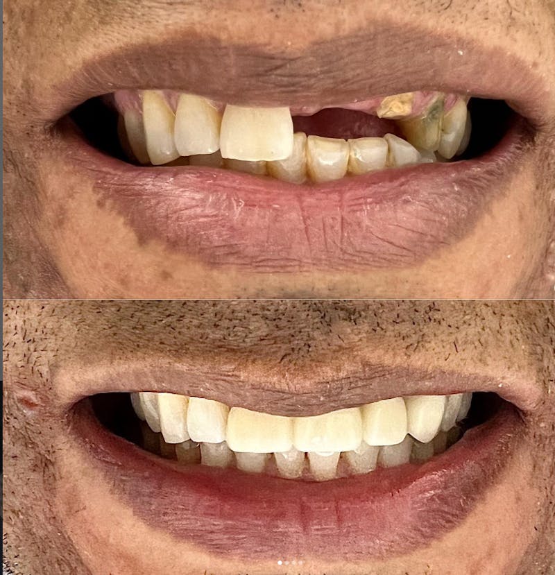 Smile Transformations Before & After Gallery - Patient 672734 - Image 1