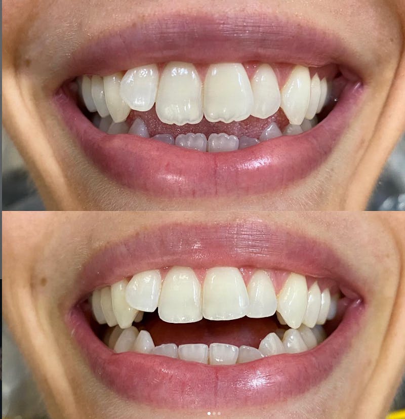 Smile Transformations Before & After Gallery - Patient 311207 - Image 1