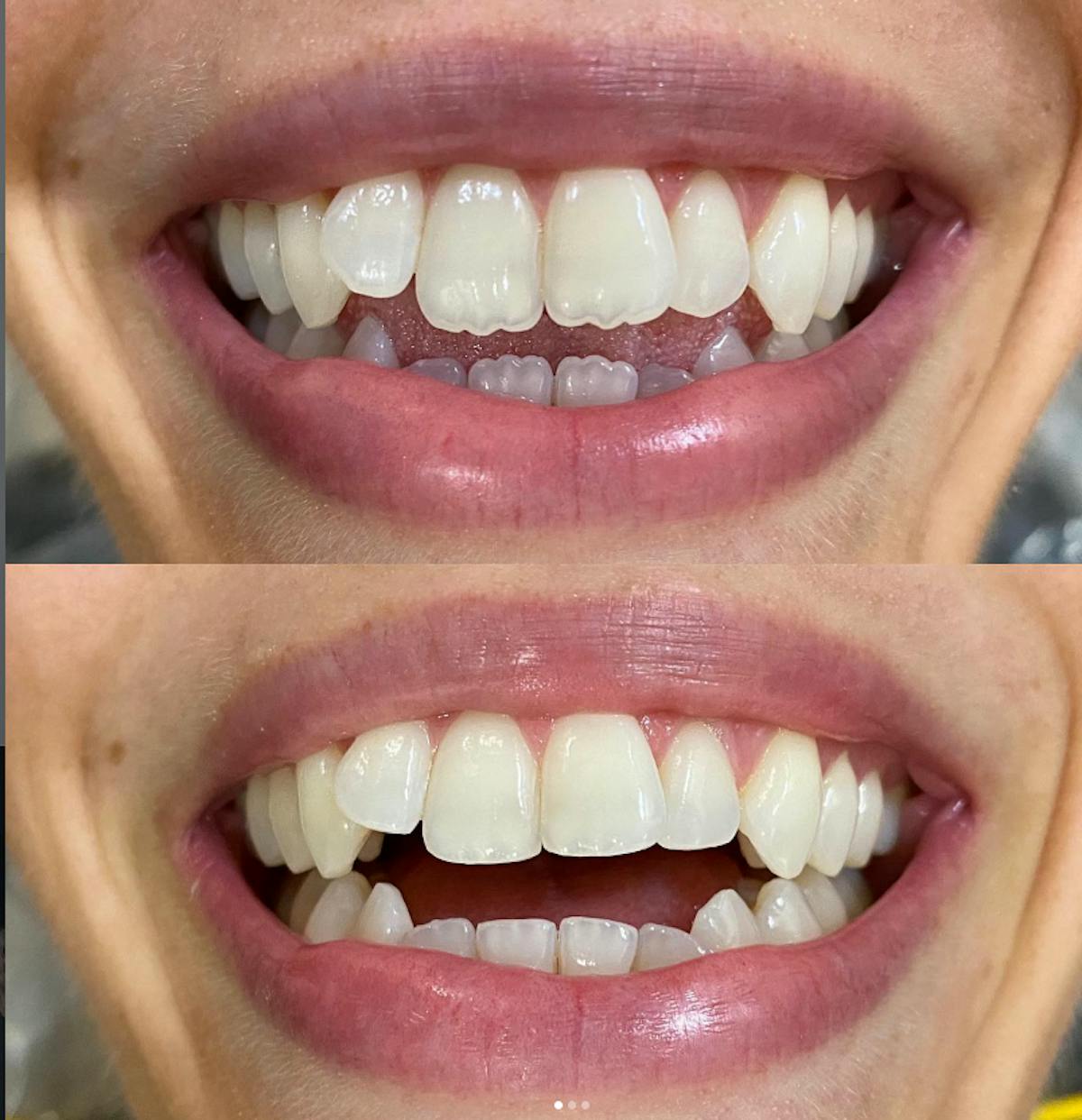 Smile Transformations Before & After Gallery - Patient 311207 - Image 1