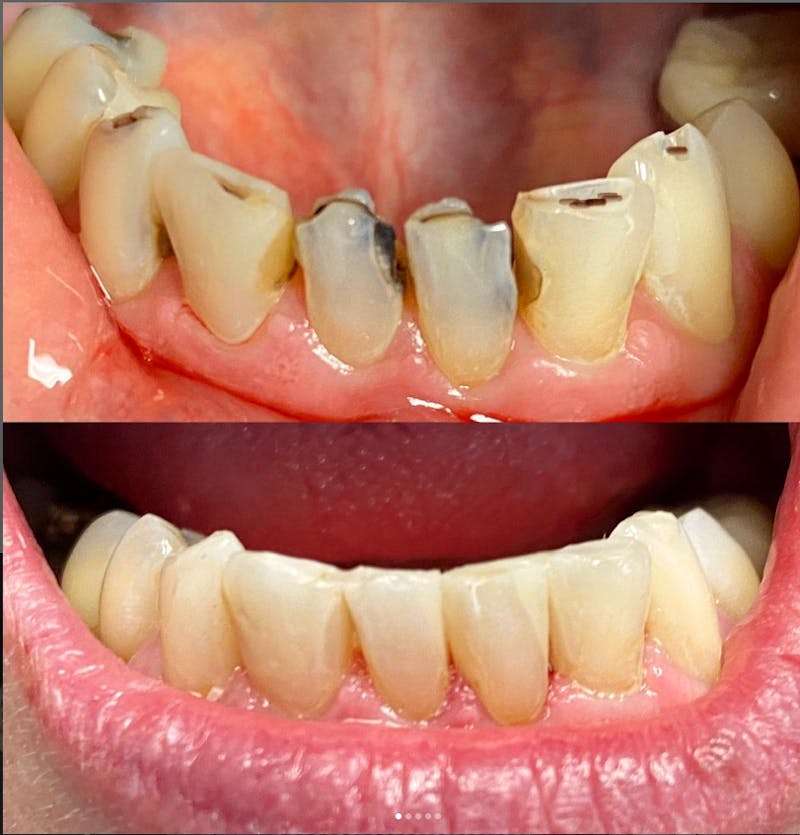 Smile Transformations Before & After Gallery - Patient 817794 - Image 1