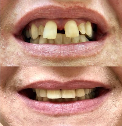 Smile Transformations Before & After Gallery - Patient 317859 - Image 1