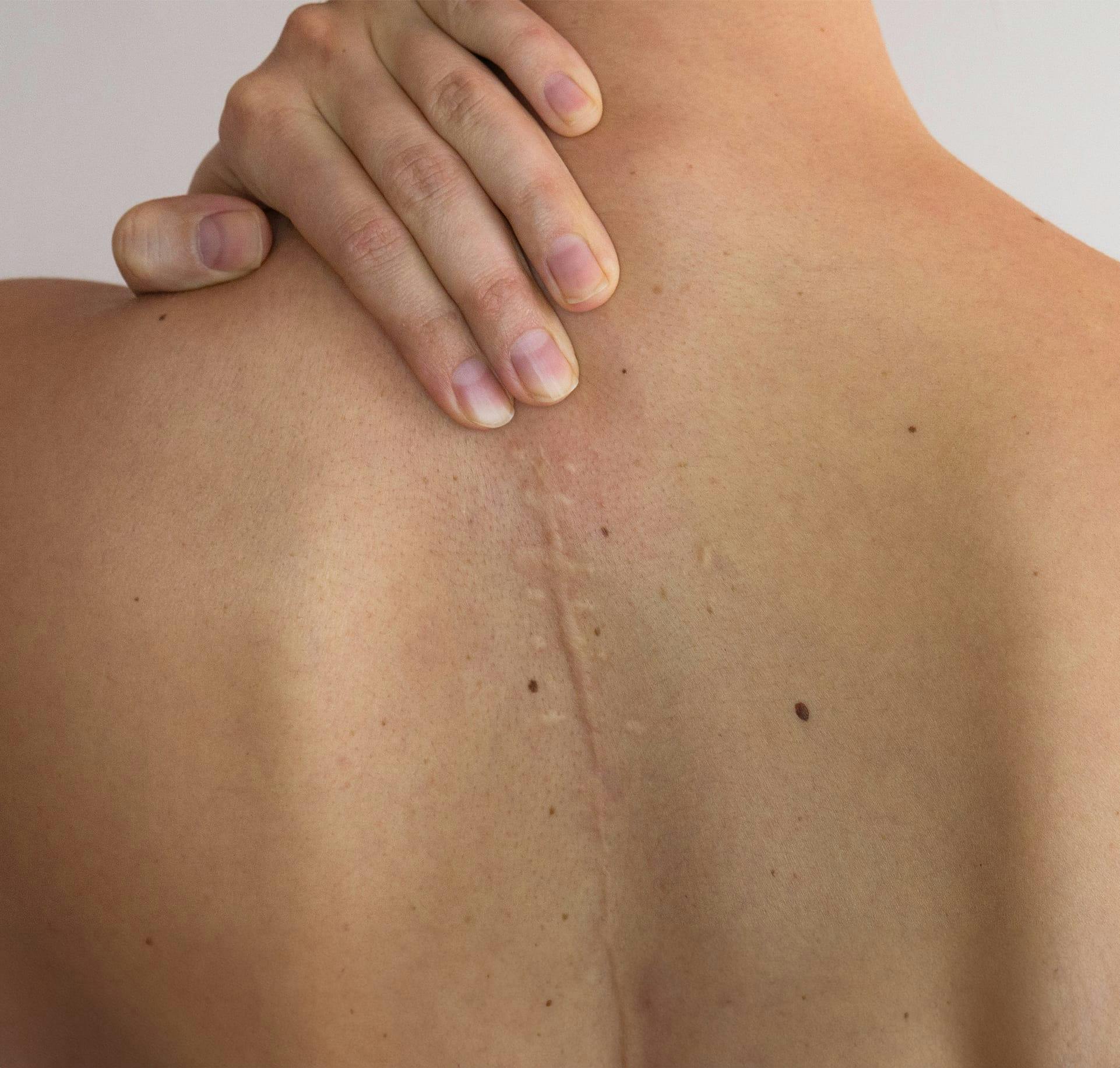 A scar on someones back
