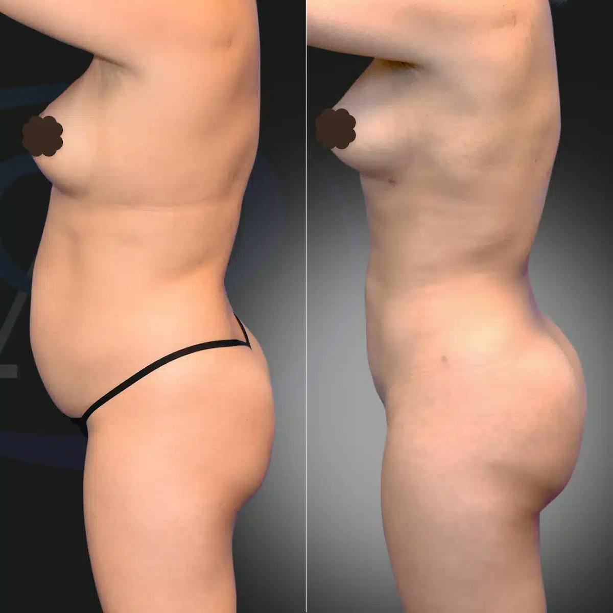 Liposuction Before & After Gallery - Patient 215965 - Image 3