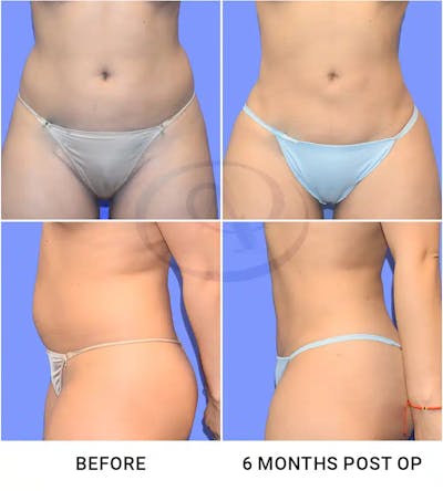 Liposuction Before & After Gallery - Patient 378393 - Image 1