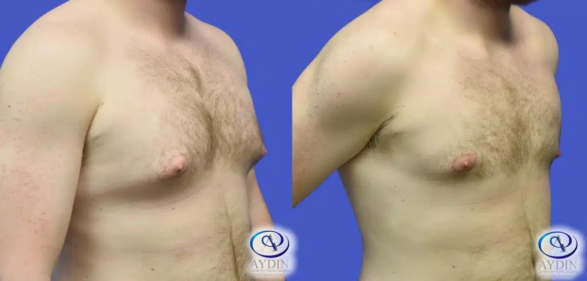 Gynecomastia Before & After Gallery - Patient 234740 - Image 1