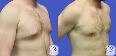 Gynecomastia Before & After Gallery - Patient 234740 - Image 1