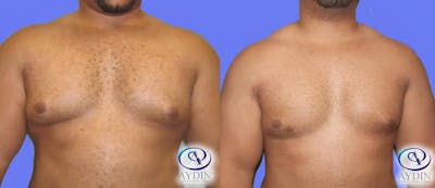 Gynecomastia Before & After Gallery - Patient 363854 - Image 1