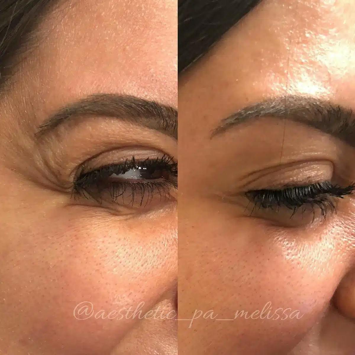 Botox Before & After Gallery - Patient 425413 - Image 1