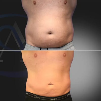 Male Liposuction Before & After Gallery - Patient 418150 - Image 1